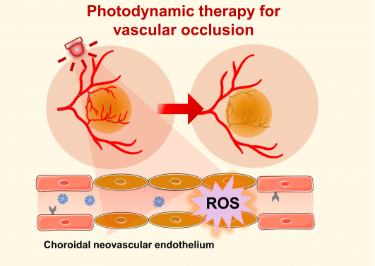 Photodynamic therapy (PDT) offers a clinical solution by utilising non-toxic photosensitisers activated by specific wavelengths of light to generate reactive oxygen species (ROS), which can damage and obliterate neovascularisation.